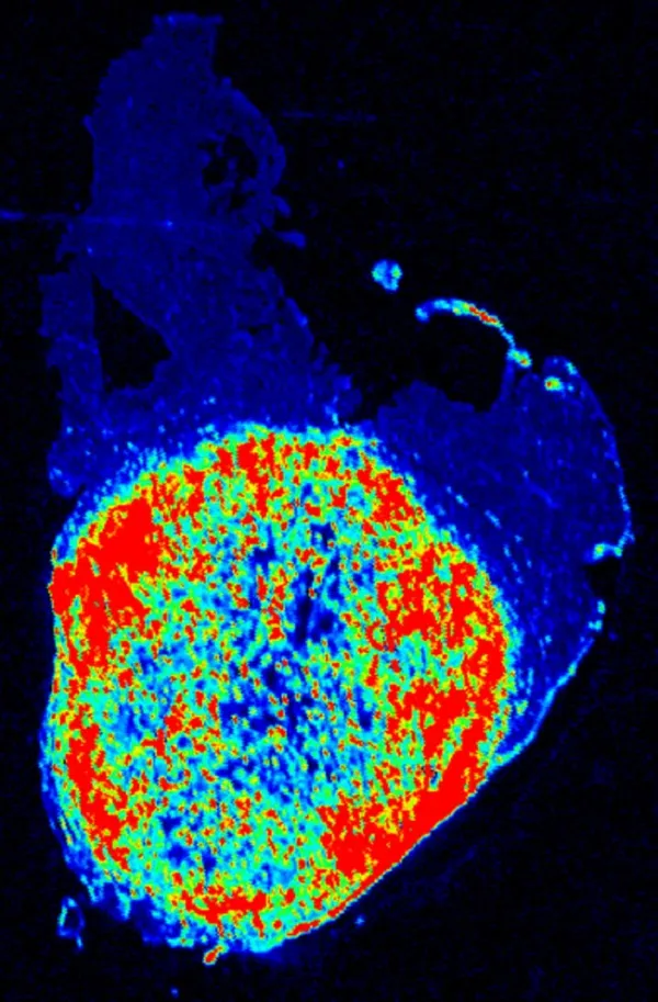 Nanosensor that lights up cancer to be tested in surgeries